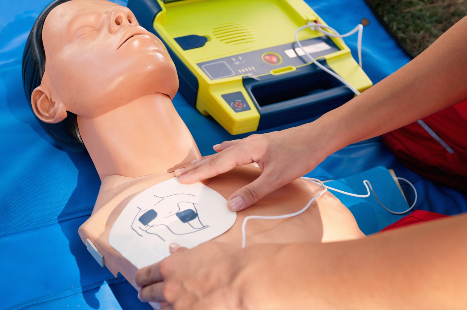 Defibrylacja co to jest, kiedy się ją wykonuje i jak działa?